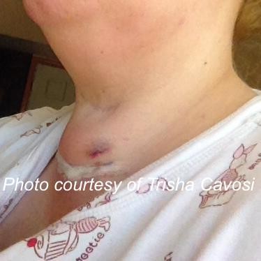 Trisha Cavosi following her surgery to eradicate thyroid cancer. Image courtesy of Trisha Cavosi. 